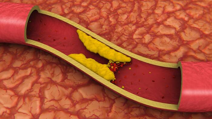 How Clogged Arteries Cause Erectile Dysfunction Harley Institute